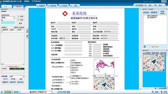 液基薄层细胞学检测系统 TBS TCT液基图文报告系统软件