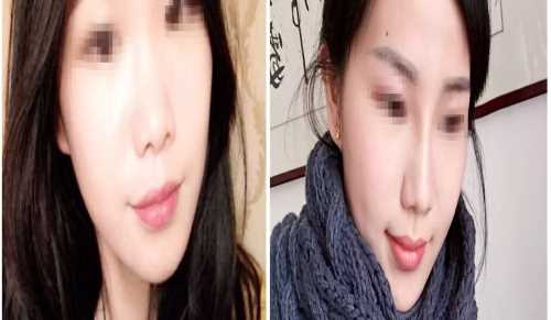 潍坊美鼻塑形哪家价格低 青岛美鼻塑形哪家便宜 山东美鼻塑形哪家便宜