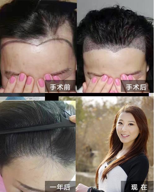 专业发际线调整多少钱_专业发际线调整_发际线调整怎么样