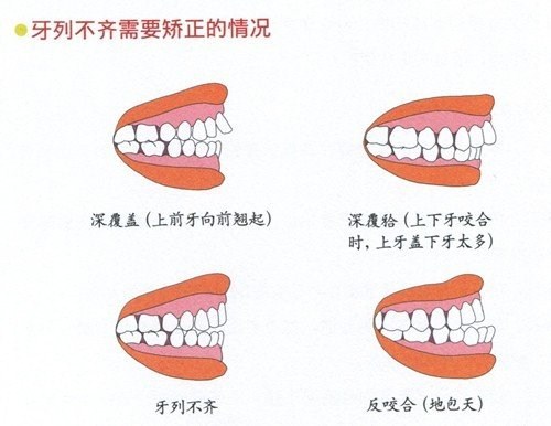 厦门牙齿不齐价格|厦门牙齿不齐价位 明山口腔供