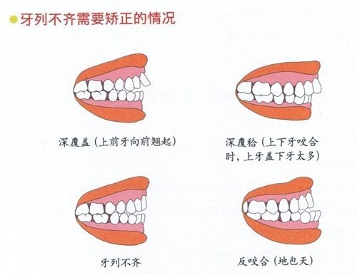 骨性龅牙戴牙套|骨性龅牙戴牙套效果图 明山口腔供