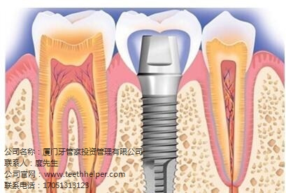 思明口腔种植牙的总结|思明口腔种植牙是什么   齿度口腔供